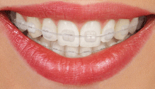 Ceramic Braces