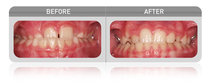 proven results - crossbite case 01