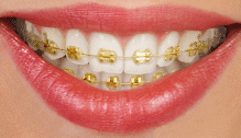 Gold Braces