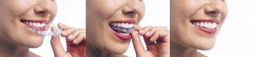 Invisalign