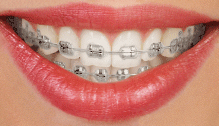 Metal Braces