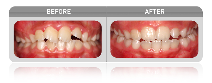 proven results - overbite case 01