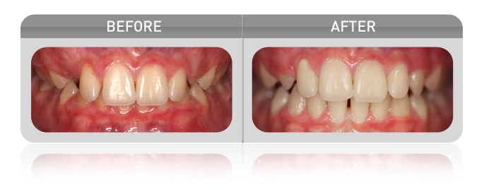 proven results - overbite case 02