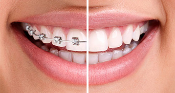 Clear/Metallic braces