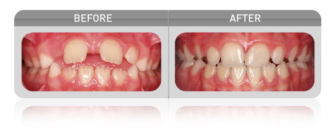 proven results - spacing case 01