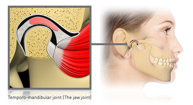 TMJ composite