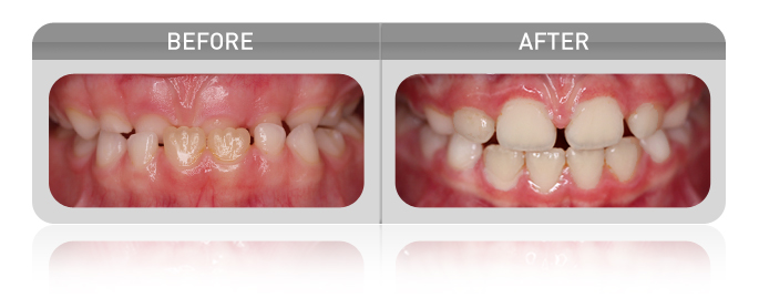 proven results - underbite case 01