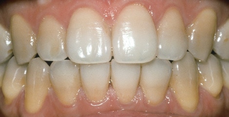 Before treatment