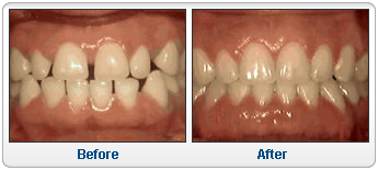 Spacing of teeth