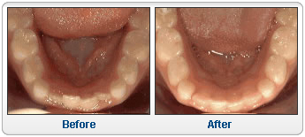 Non-braces treatment