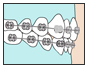 Loose Bracket