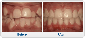 Crowding of the teeth