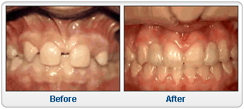 Missing lateral incisors